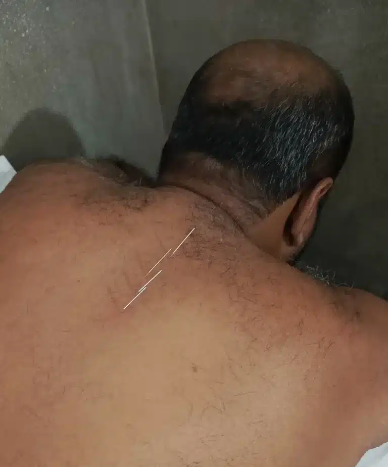 dry needling treatment in lahore