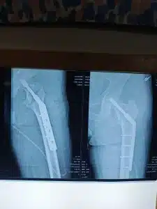 neck of femur fracture physiotherapy treatment lahore