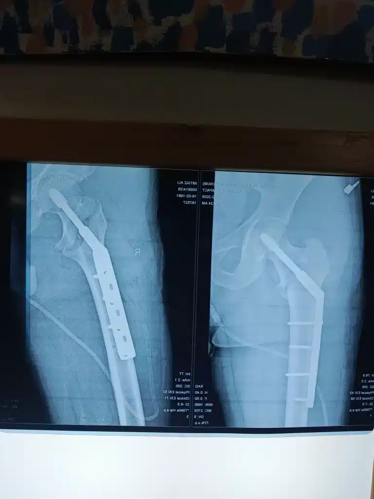 neck of femur fracture physiotherapy treatment lahore