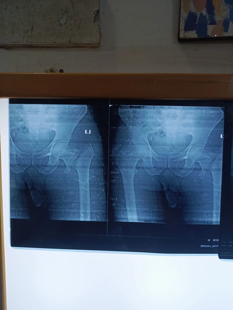 Neck of Femur Fracture: Causes, Treatment & Physiotherapy Rehabilitation Guide 1 neck of femur fracture physiotherapy treatment lahore1747573680512326682