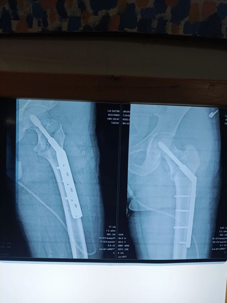 Neck of Femur Fracture: Causes, Treatment & Physiotherapy Rehabilitation Guide 2 neck of femur fracture physiotherapy treatment lahore3941275281547254317