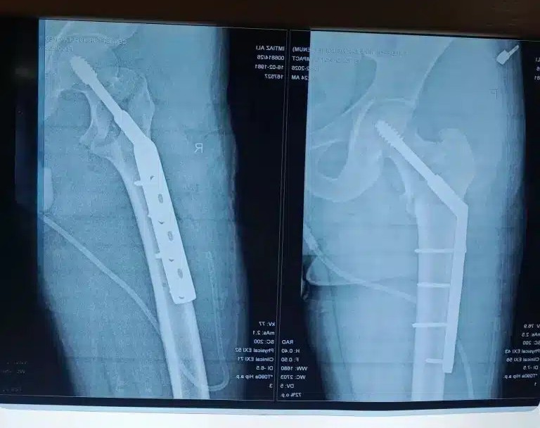Neck of Femur Fracture: Causes, Treatment & Physiotherapy Rehabilitation Guide