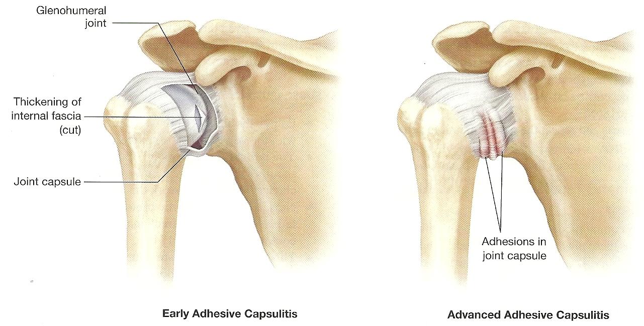 Frozen Shoulder (Adhesive Capsulitis): Causes, Symptoms & Best Physiotherapy Treatment in Lahore
